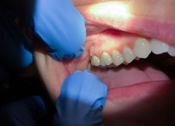 Best Emergency Dental Care for Sports Injuries in Columbia, PA